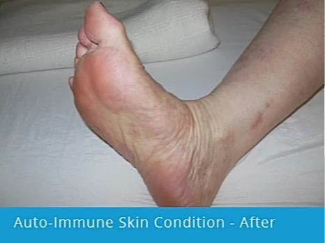 Auto-Immune Skin Condition on Foot – After