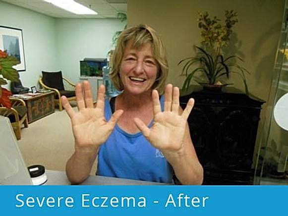 Severe Eczema – After