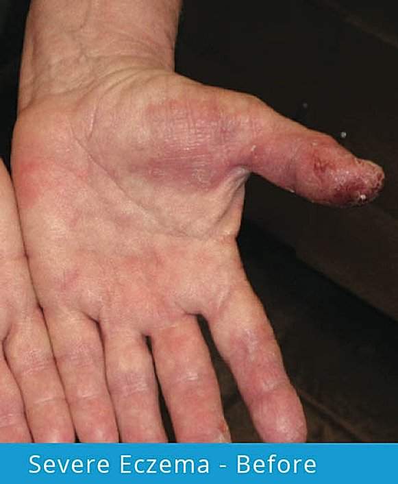 Severe Eczema – Before