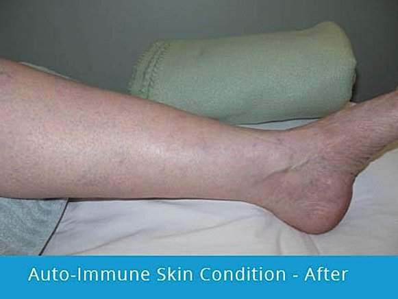 Auto-Immune Skin Condition – After