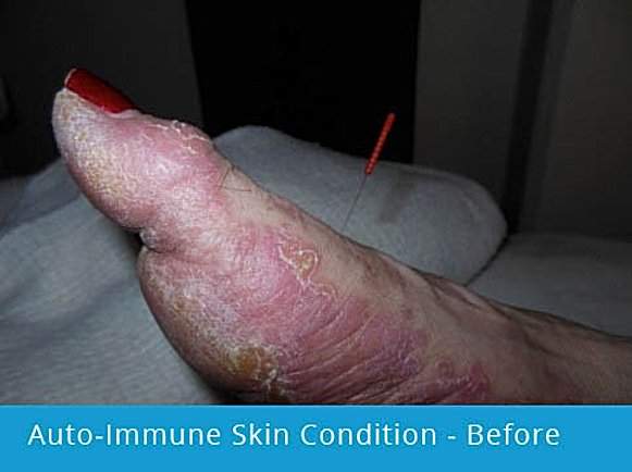 Auto-Immune Skin Condition - Before